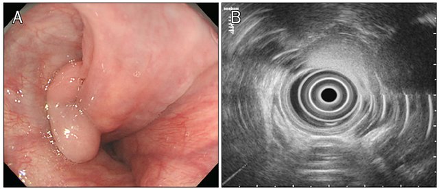 Endosonografi